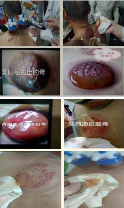 岐黄之道、吸透为本 ——黎阳、张德凤